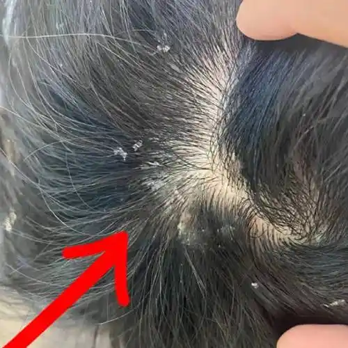 产生头皮问题原因如下:头皮屑的产生通常有多种原因,包括:皮脂过多