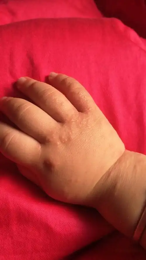 不发烧不发热,嘴里没有疱疹排除手足口病.