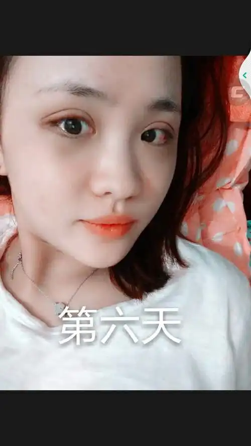 下图是埋线双眼皮一个半月,第六天,第三天 和没做前.感觉怎么样