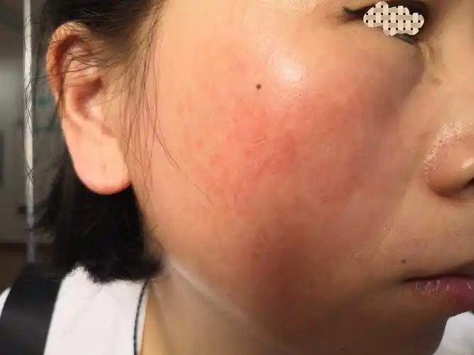 面部红斑红血丝治疗案例