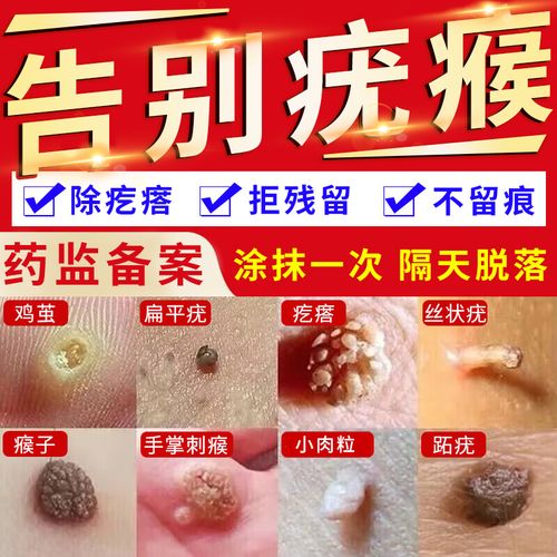 扁平疣专用药-特价促销-优惠券领取-价格|多少钱|什么牌子好-35优惠券