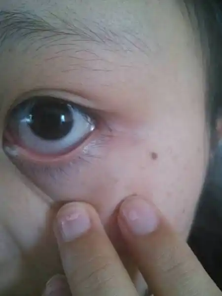 问:我的眼睛水肿好几个星期了,医生说点眼药水,可是没用,昨天又复发了