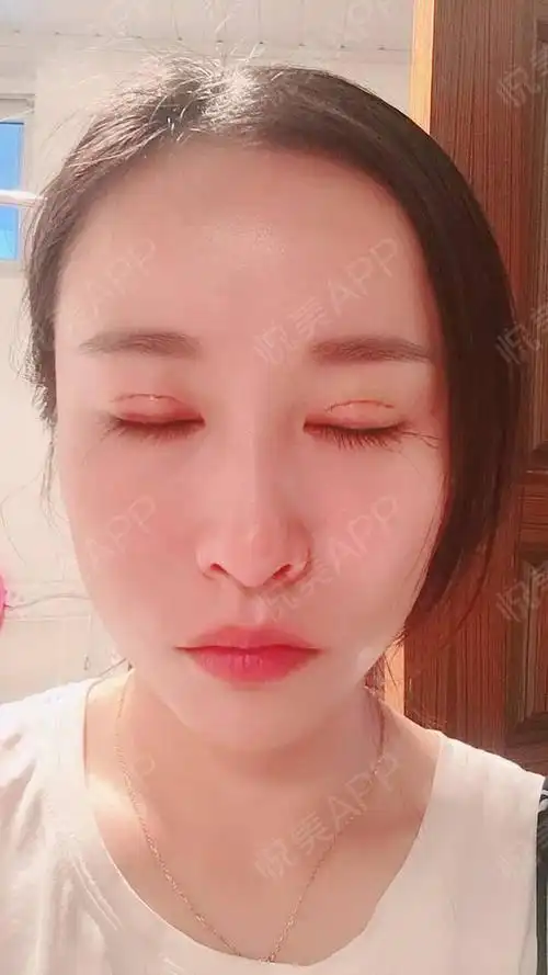 全切双眼皮术后7天_开眼角术后7天_双眼皮术后7天_眼部整形术后7天
