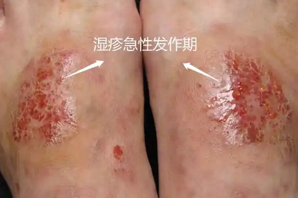 湿疹急性发作期图片