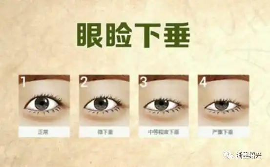 眼睑下垂眨眼困难? 当心这是重症肌无力在作怪!