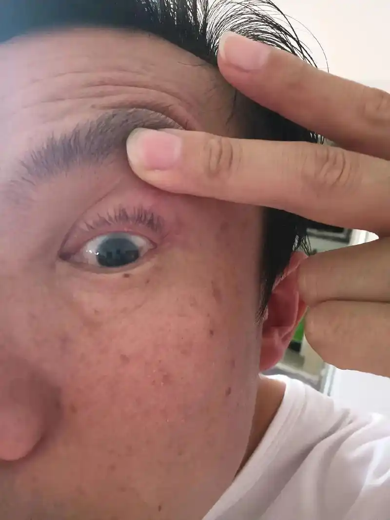 我前天晚上熬到两三点才睡,这是我本人昨天早上起来发现左上眼睑 - 抖