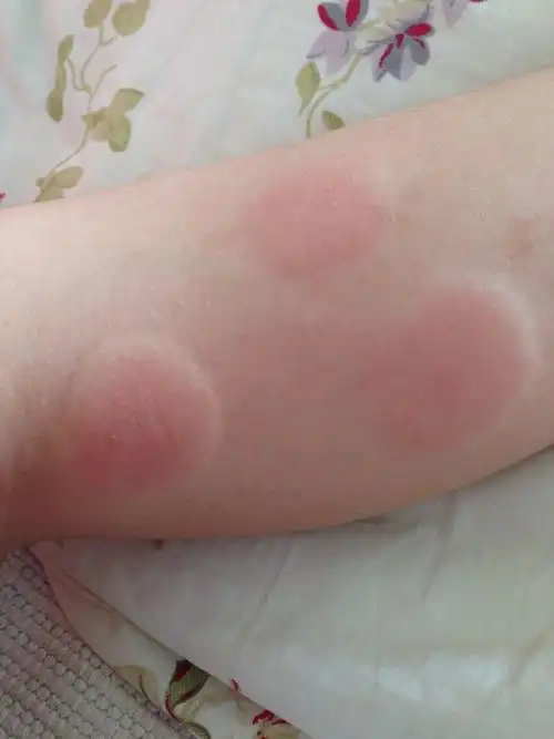 尤其是三伏天,潮湿闷热的天气,心情本来就不爽,再让蚊子叮几个硬包