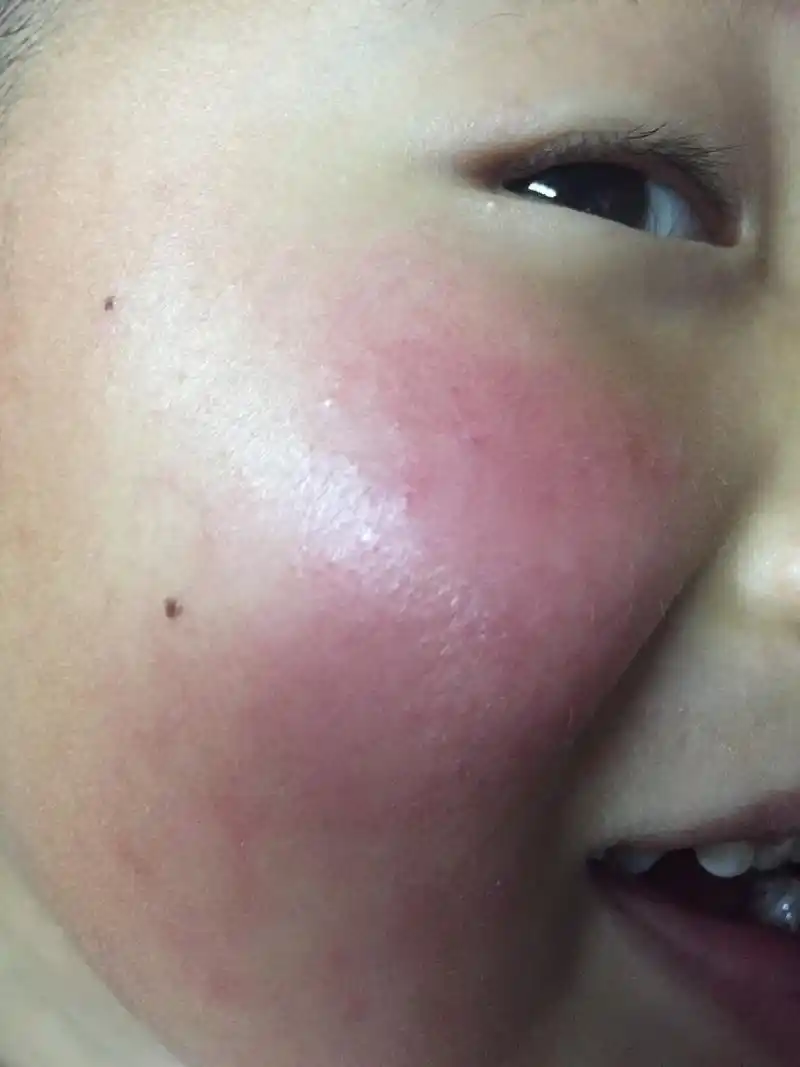 孩子积食导致肠胃病和腺样体肥大!医生详解如何帮助孩子消积食