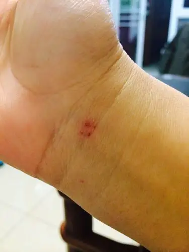 最近两天手腕上出了四个很整齐的小红点,不