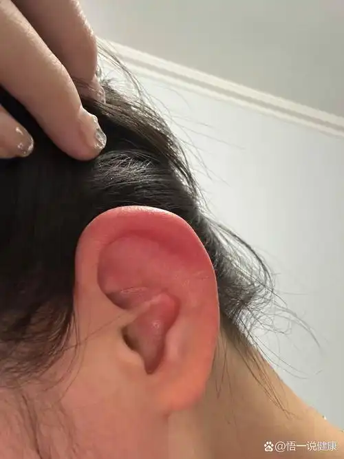 耳朵冻肿了怎么办?