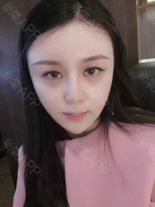 自体脂肪面部填充