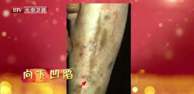 腿上有这种斑当心糖尿病胫前色素斑保护腿足这些方法很实用