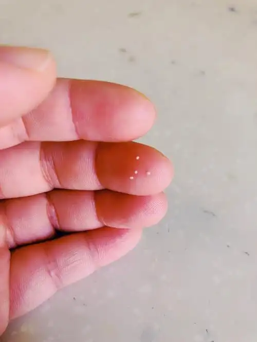 请教各位,脸上长白色小豆豆,挤出来是这样的,是脂肪粒吗,怎么能治好