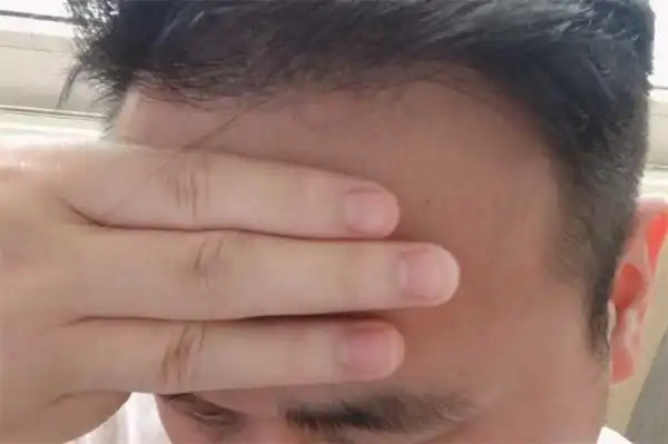 正常发际线在哪个位置