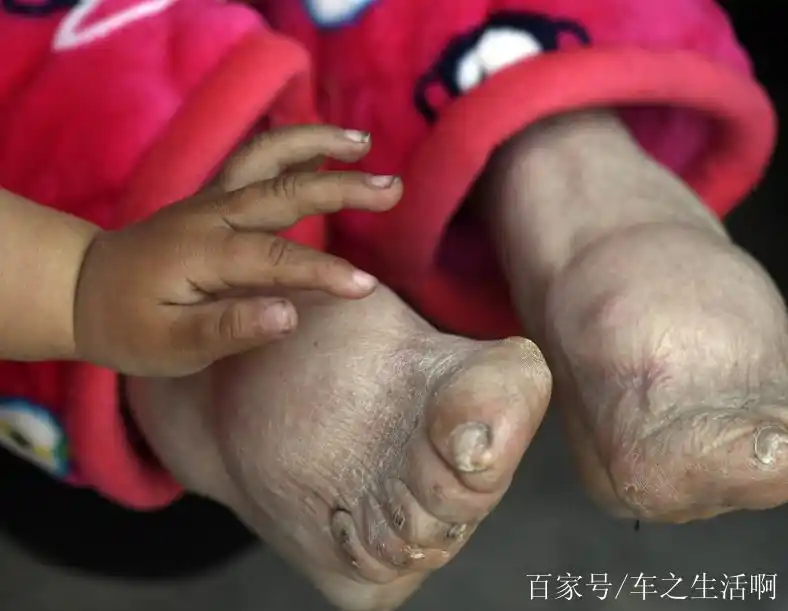 农村百岁"裹足女人"3岁缠足,与百岁老伴相爱81年,网友:祝福