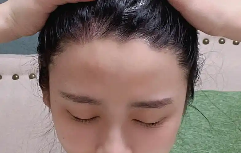 植发214天 半年了效果还行 还没完全长全 问医生发际线形状跟预期有点