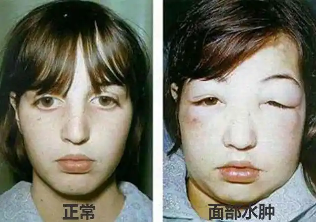 水肿图片慢性肾炎水肿图片肾病眼睑浮肿/水肿图片肾病早期面部水肿