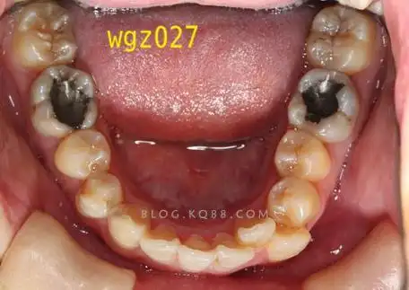 思考她的下颌尖牙如何排入牙列的原创