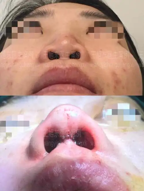 binder综合征是颅颌面外科的常见疾病,其发病机理目前还不是十分清楚.