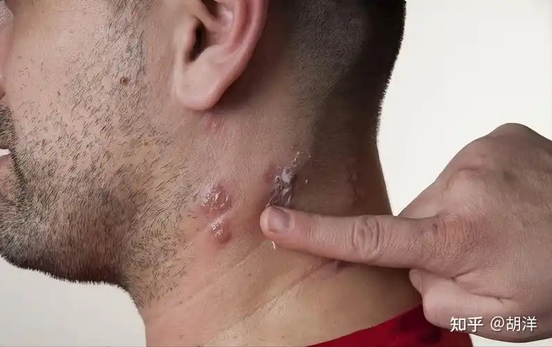 之所以会有这种说法,主要是不少癌症病人在确诊之前发生过带状疱疹