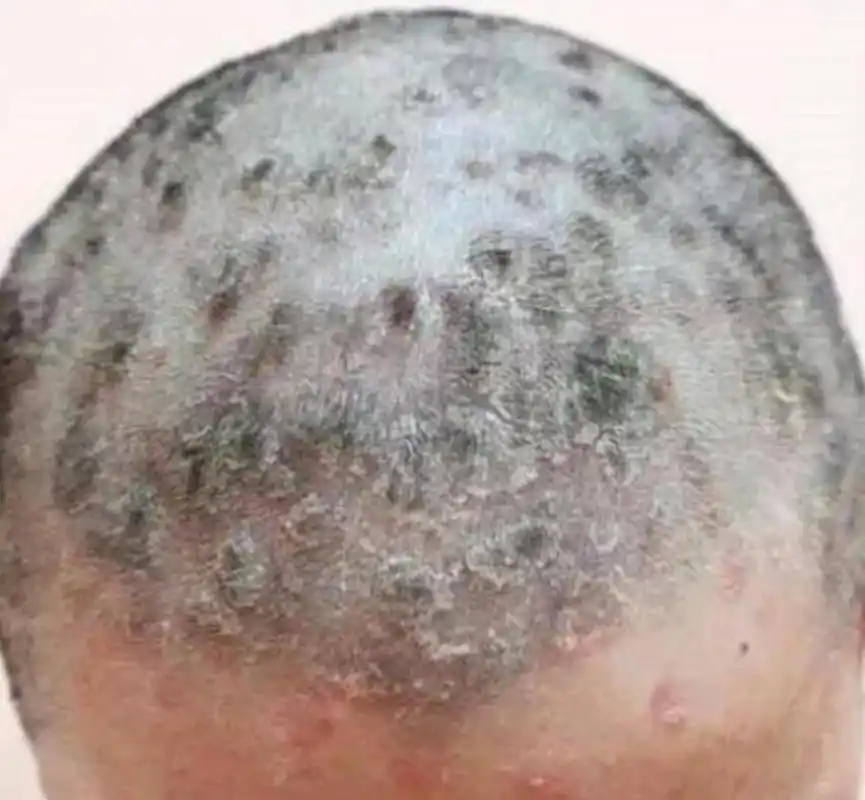 头上长了银屑病,牛皮癣,一定要剃发吗?