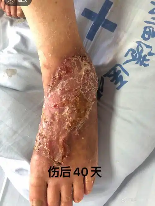 功能基本无异完整版左足碾压开放伤