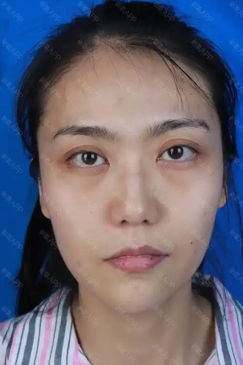 自体脂肪全脸填充第0天