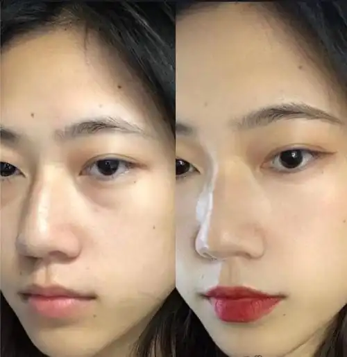 泪沟填充的材料怎么选?