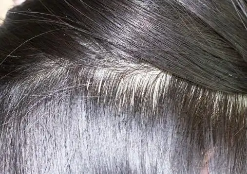 脱发绝招:多种慢性脱发,一个方法防脱生发!