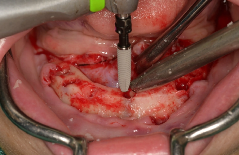 病例分享 | 下颌无牙颌种植固定修复一例_百齿泰_种植牙_百齿泰(厦门)