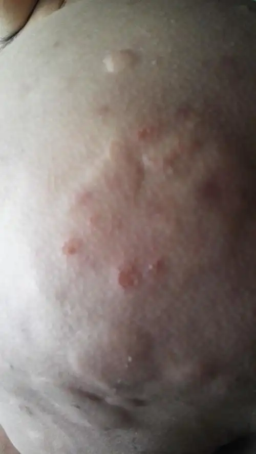 屁股有一块块的包似的,会痒是什么东西