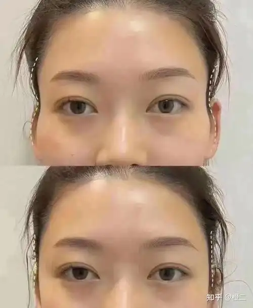 玻尿酸填充效果实测塑形下巴太阳穴额头法令纹玻尿酸到底有用吗