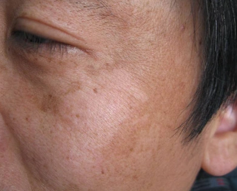 脸上肝斑图片54