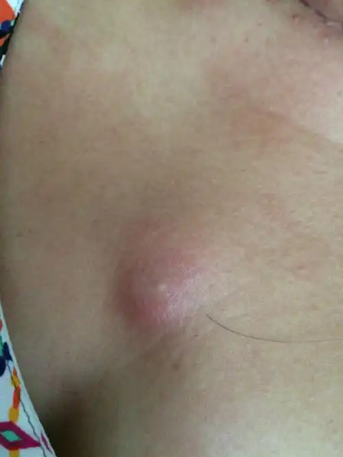 请问这个是什么,胸口长的,越来越大了,而且现在又疼又痒,以前小的时候