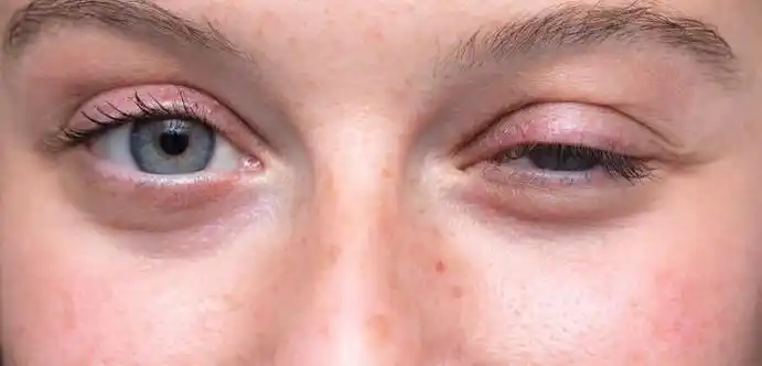 肌无力的症状 - 早旭经验网