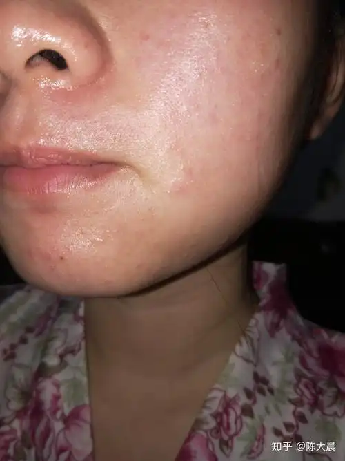 激素脸别再入坑了