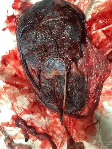 注意,主胎盘娩出后若副胎盘残留宫腔,可致产后出血和感染.