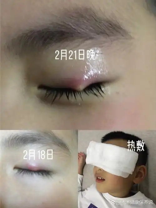 第一次手术(霰粒肿)5岁