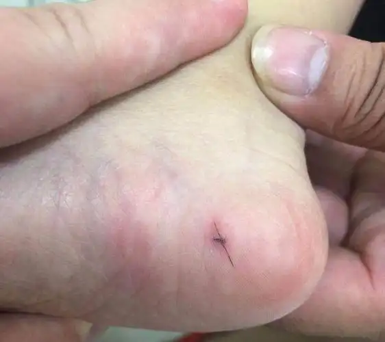 小宝宝脚底突现"黑虫",还会变形!取出一看竟是