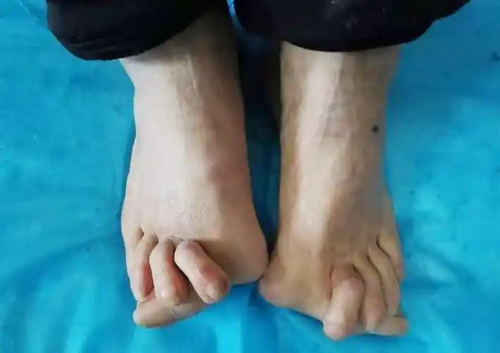【汤汤播报】 这样的大脚骨,看着都疼……_治疗