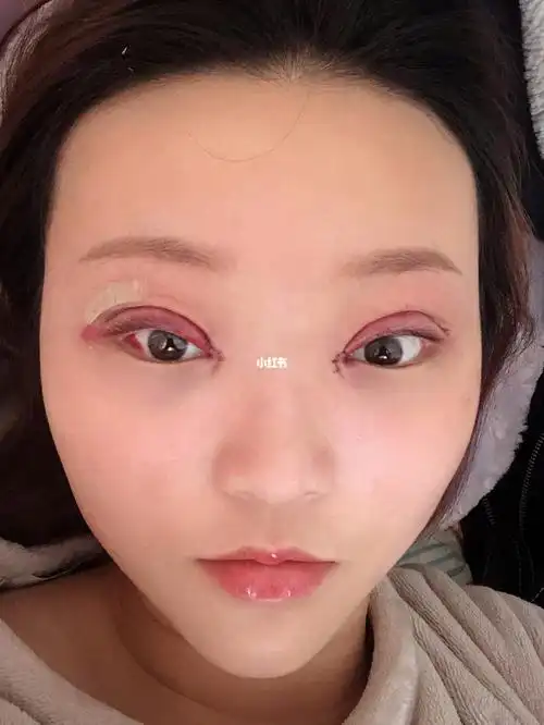 双眼皮手术后第24小时左右_双眼皮手术_双眼皮_美颜自拍_兰州双眼皮
