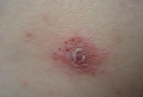 疥疮结节图片 (9)