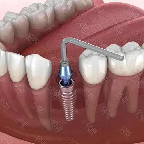 厦门常见十大种植牙品牌价格表,看看你中意的品牌多少钱