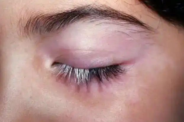 先天局限性白发病