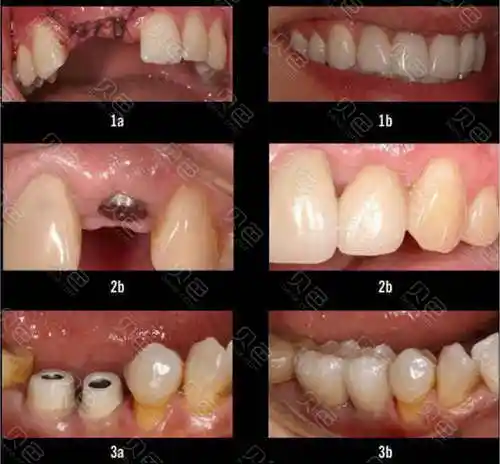 揭秘:种植牙寿命有多少年?种植牙有什么风险和后遗症!