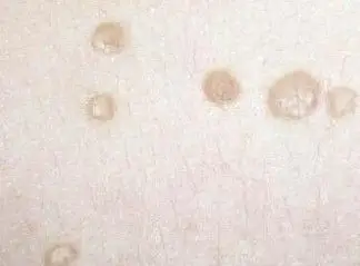 扁平疣较佳治疗方法