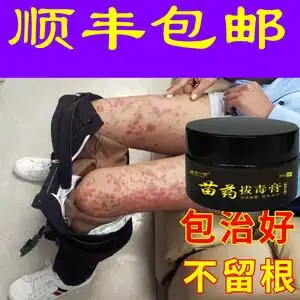 治疗顽固牛皮癣银屑廯头皮手足癣体股藓皮肤抑菌瘙痒止痒专用药膏