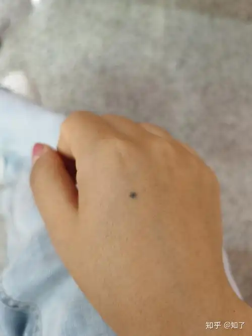 手上长了颗蓝色的痣我好方请懂的人帮我看一下好不好有问题? - 知乎