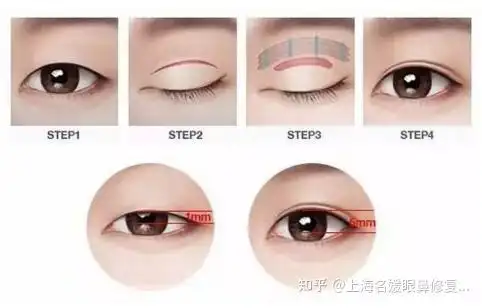 双眼皮全切和埋线哪个比较好