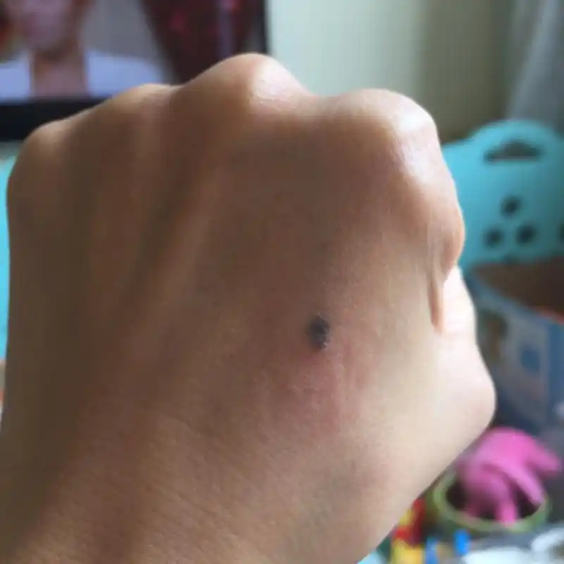 帮忙看看我手背的这个颗痣,我想去医院手术切了它,怕他变得不好了